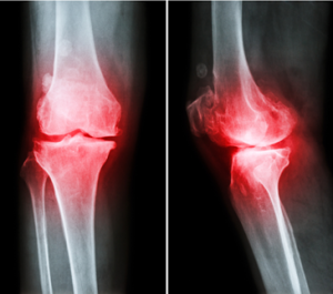 knee pain in Overland Park