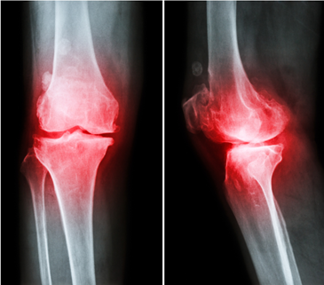 knee pain in Overland Park