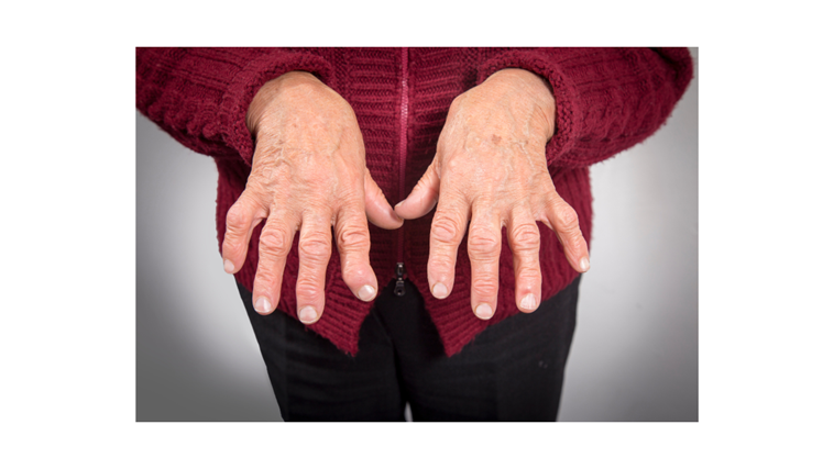 Osteoarthritis treatment in Overland Park